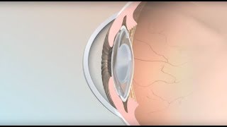 HOW TO Insert  remove contact lens for beginners  NANCI [upl. by Affrica503]