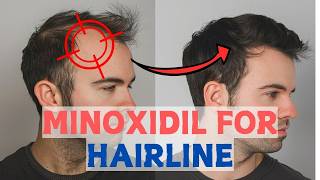 Minoxidil for Frontal Baldness  Restore Your Hairline [upl. by Jeanna]