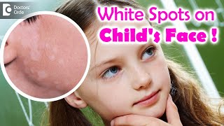 5 Things to know if your child is suffering from Pityriasis Alba  Dr Divya SharmaDoctors Circle [upl. by Warms]