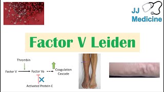 Factor V Leiden  Causes Pathophysiology Symptoms Diagnosis Treatment [upl. by Arick]