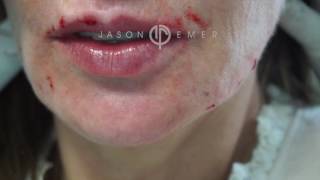 Belotero Lip Filler For Fine Lines amp Wrinkles Treatment  Smoker Lines Filler  Dr Jason Emer [upl. by Lashond]