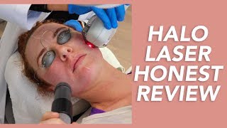 My Halo Laser Experience Honest Review Recovery and Before amp Afters [upl. by Etteuqram598]