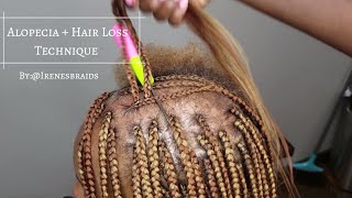 NEW TECHNIQUE ALOPECIA  HAIR LOSS BOX BRAIDS  IRENESBRAIDS [upl. by Leeann]