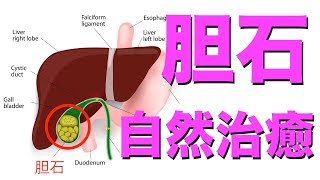 胆石の食事療法：胆のう結石の予防と改善法 [upl. by Ellekram418]