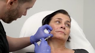 Facial Sculpting with Belotero Balance Soft Dermal Filler  Facial Rejuvenation by Dr Jason Emer [upl. by Leahcimdivad]