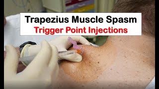 Trapezius Muscle Spasm Trigger Point Injection [upl. by Hortense53]