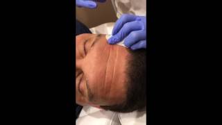 Deep Forehead Lines Removed by Belotero Filler in NYC [upl. by Patten]