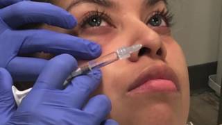 Belotero Injections to Correct the Tear Trough Hollow [upl. by Ntisuj]